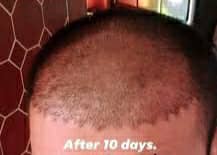 بعد عشرة أيام من زراعة الشعر