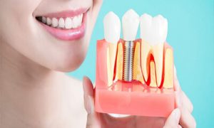 عملية جراحة زراعة الأسنان