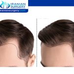 زراعة الشعر في ايران