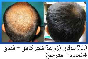 زراعة الشعر في شیراز