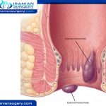 علاج البواسير الداخلية