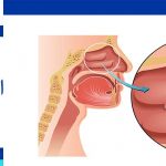 علاج السلائل الأنفية في ایران