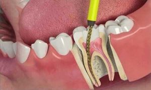 عملیة علاج جذور و العصب الاسنان