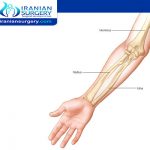 علاج ذراع مکسورة في ایران