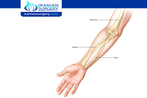 علاج ذراع مکسورة في ایران