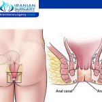 علاج شق شرجي في ایران