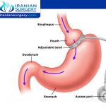 عملیة حلقة المعدة في ایران