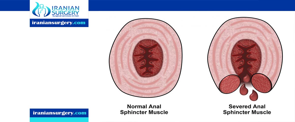 bowel incontinence