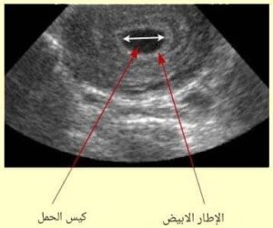شكل كيس الحمل بعد ترجيع الاجنة