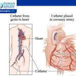 ما هي اسباب القسطرة القلبية؟