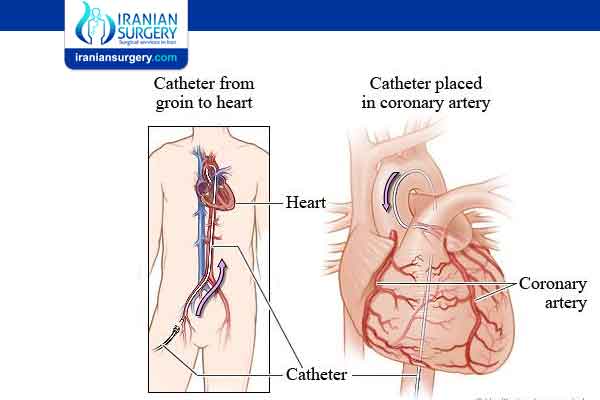 ما هي اسباب القسطرة القلبية؟