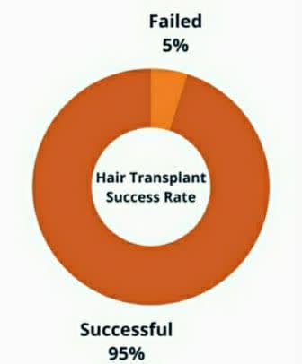 نسبة نجاح عملية زراعة الشعر